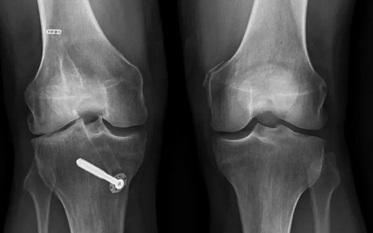 Stem Cell Therapy for Knees