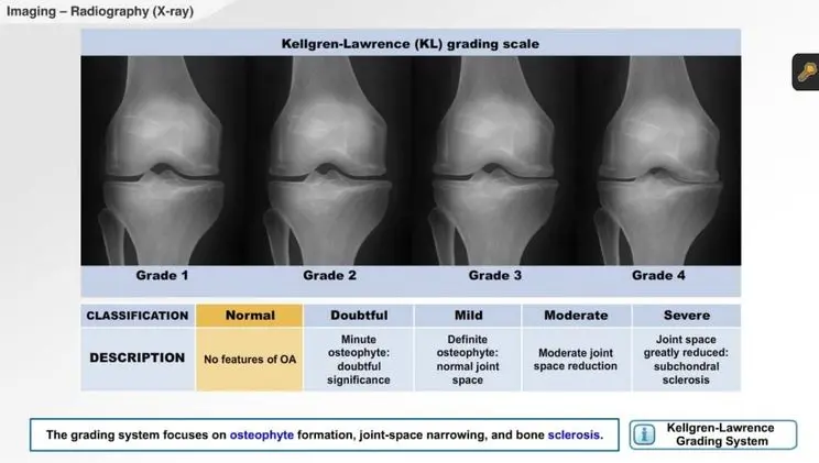 Stem Cell Therapy for Arthritis: What you should know
