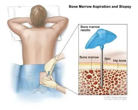Bone marrow stem cells