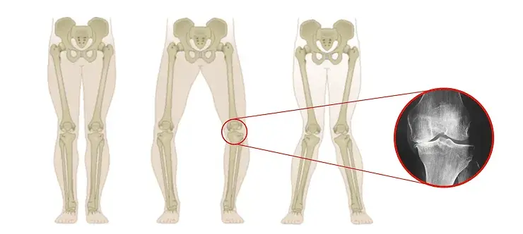 arthritis