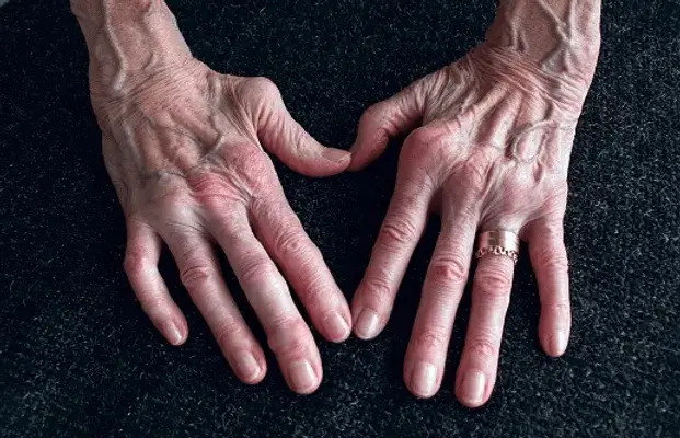 rheumatoid