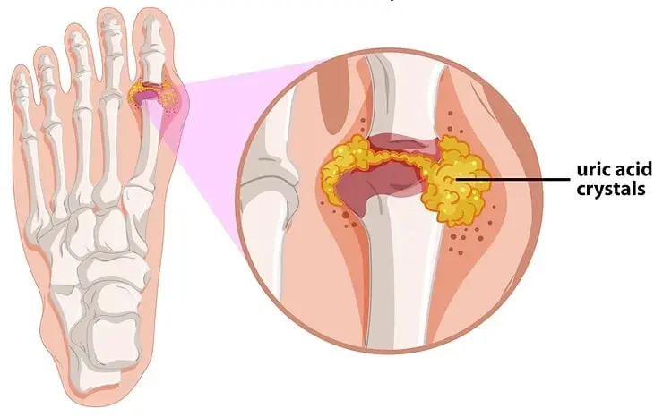 uric-acid-crystals-foot Gout explained