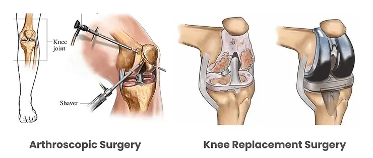 knee arthritis explained