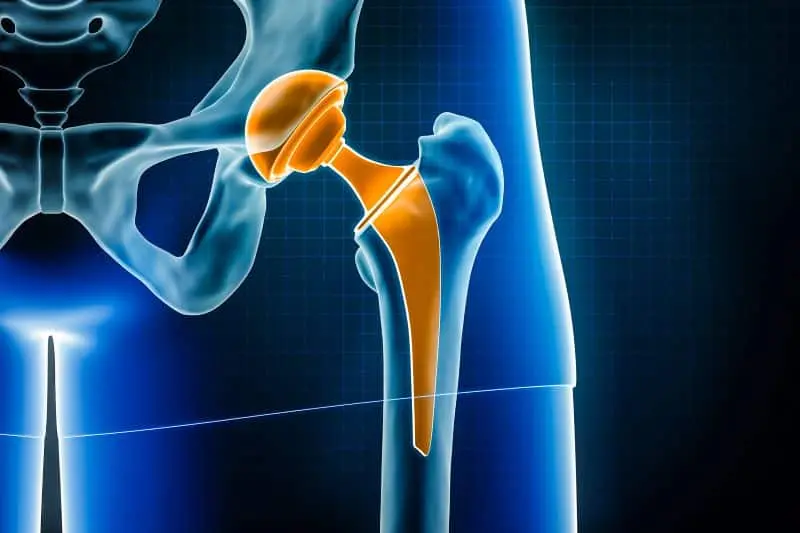 How Orthopedic Surgeons Help Restore Mobility After a Fracture