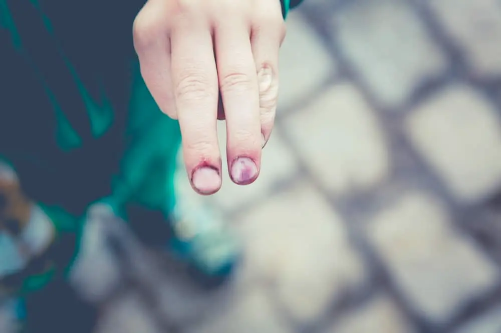 fingers that look wounded fingers that look wounded
