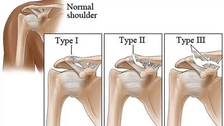 AC Joint Separation