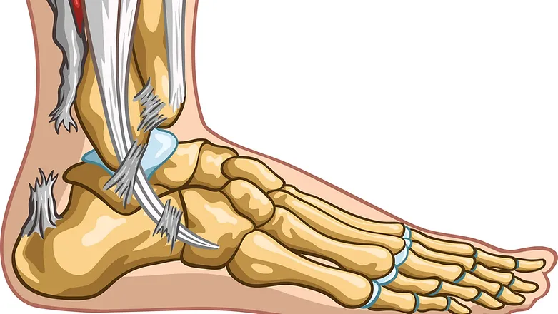 Achilles Tendon Rupture