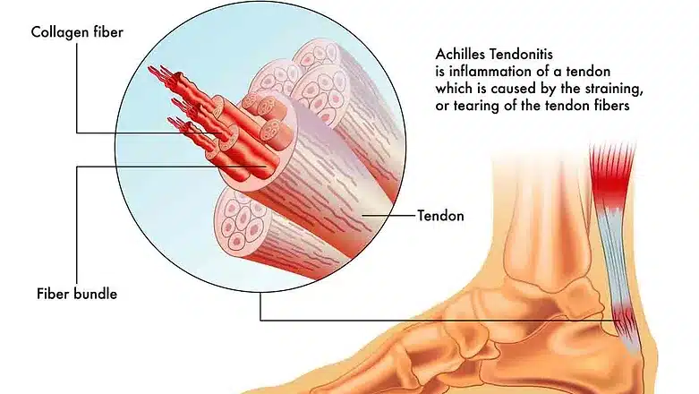Achilles Tendonitis