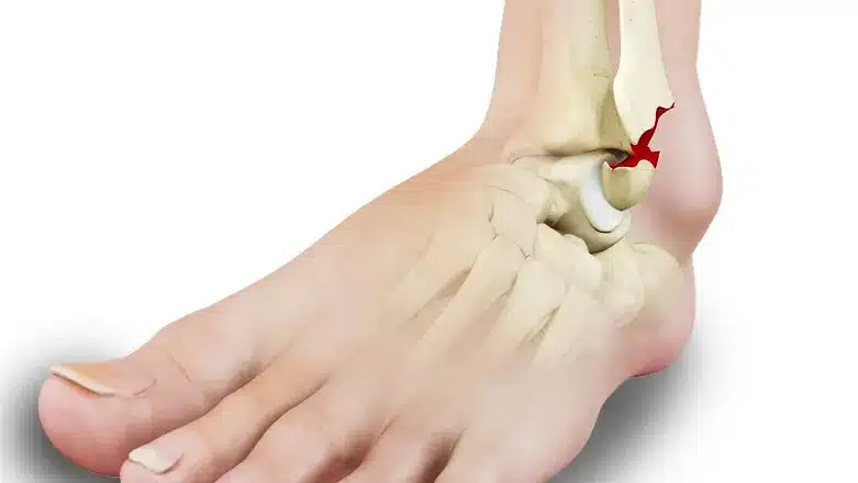 Ankle Fracture