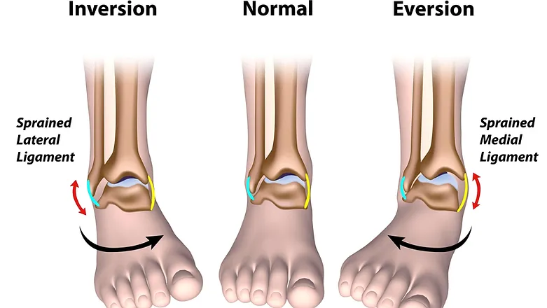 Ankle Sprain Strain
