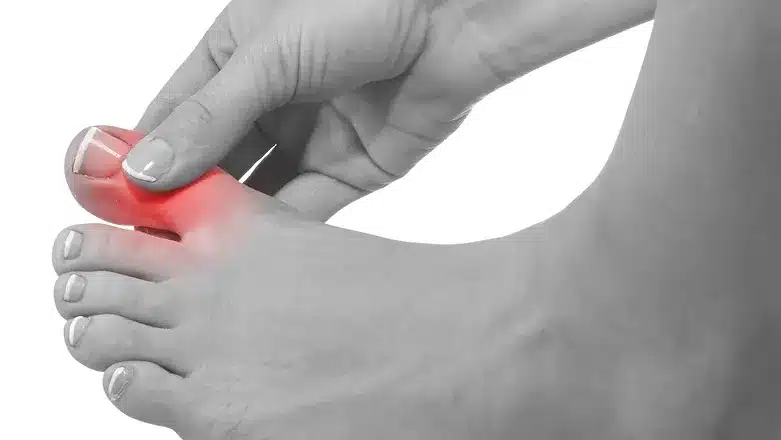 Big Toe Arthritis 1
