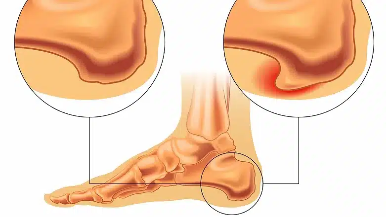 Calcaneal Spur
