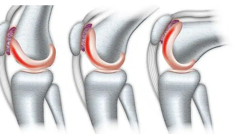 Chondromalacia Patella