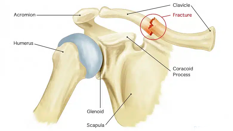 Clavicle Fracture