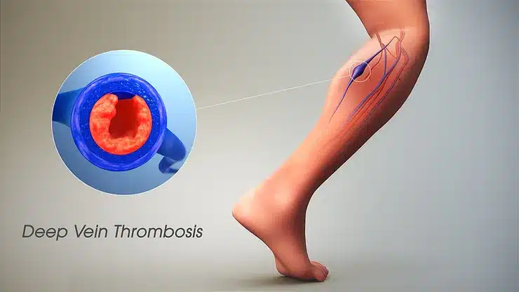 Deep Vein Thrombosis