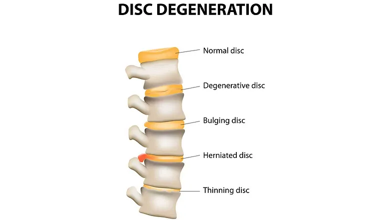 Degenerative Disc Disease