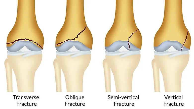 Distal Femur Fracture 1