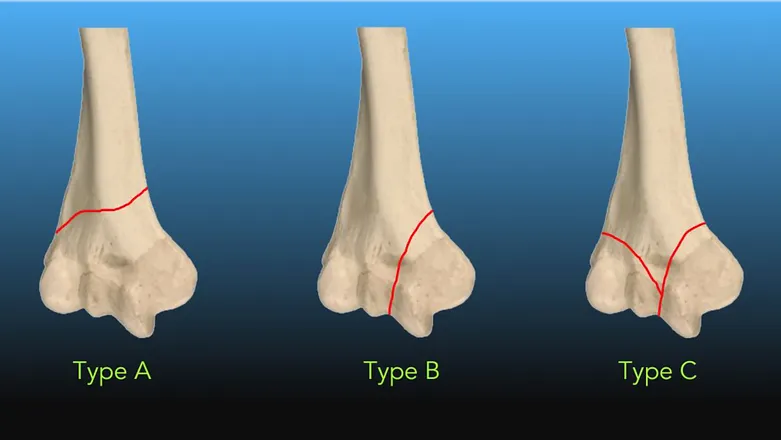 Distal Humerus Fracture