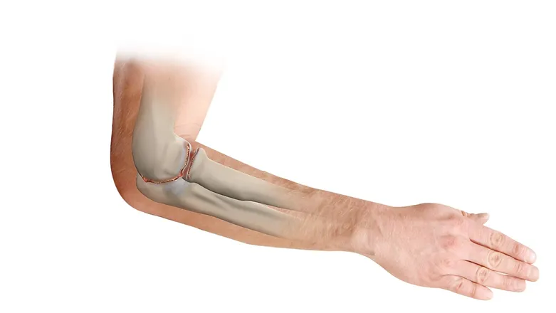 Elbow Arthritis