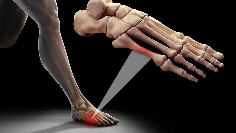 Foot Fracture