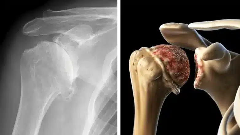 Glenohumeral Joint Arthritis