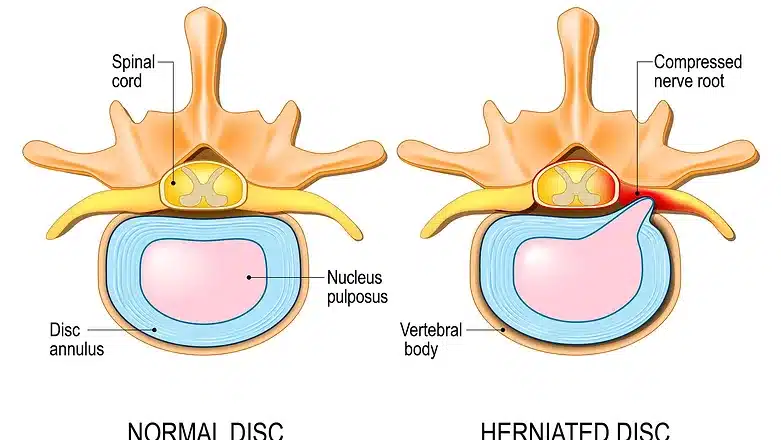 Herniated Disc