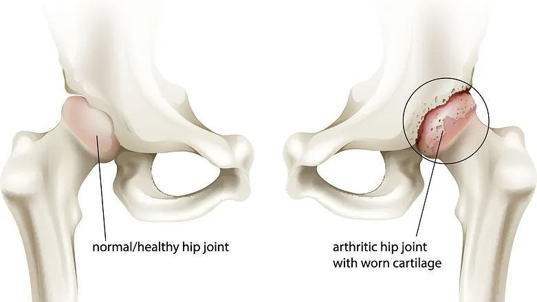 Hip Arthritis