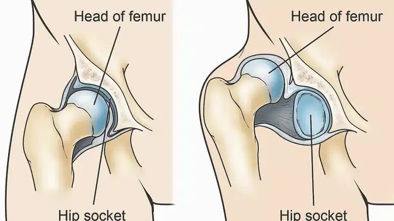 Hip Dislocation