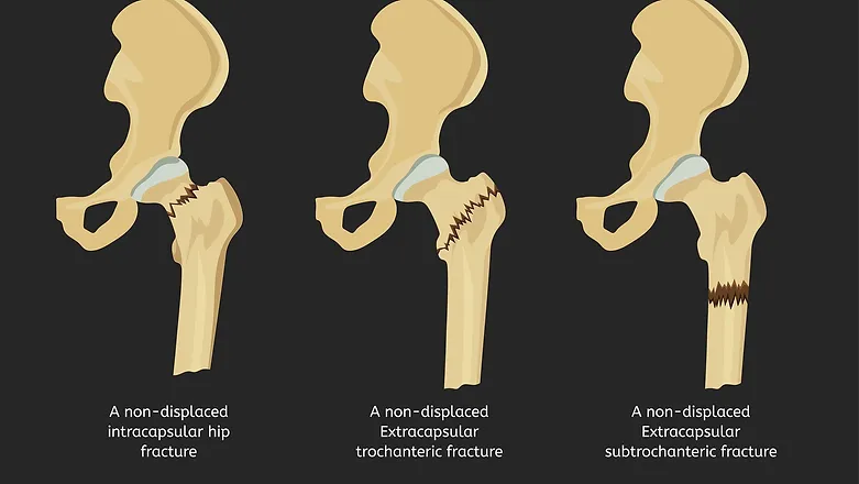 Hip Fracture