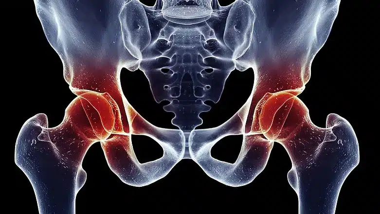 Hip Impingement 1