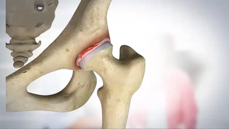 Hip Labral Tear