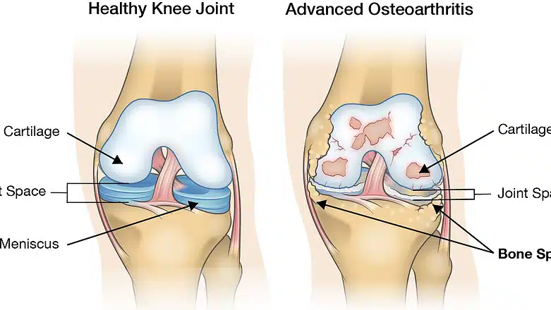 Knee Arthritis
