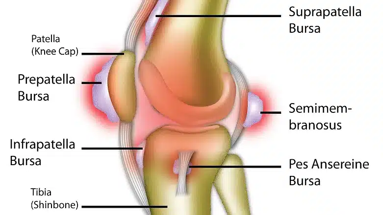 Knee Bursitis
