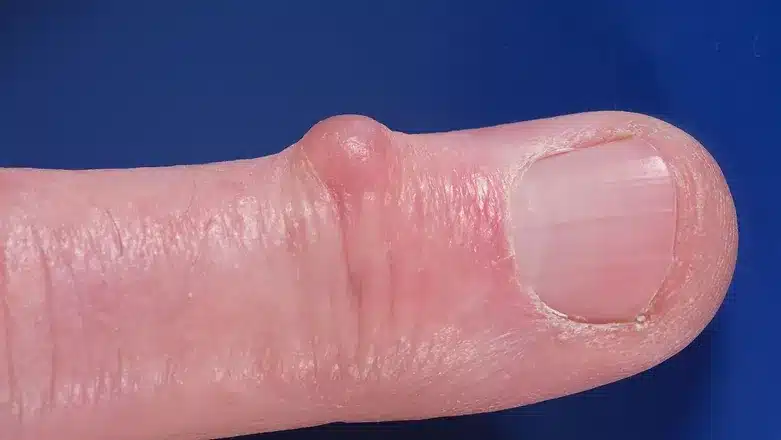 Mucus Cyst