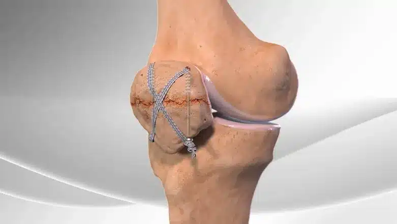 Patella Fracture