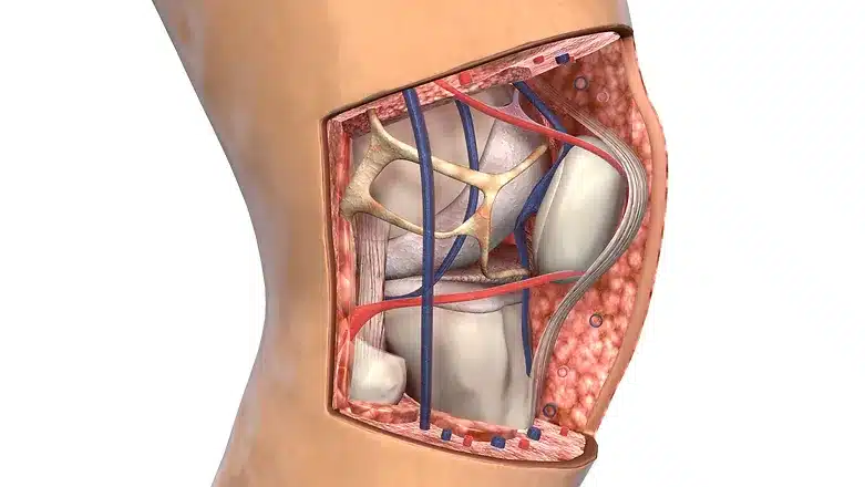 Patellar Tendinitis