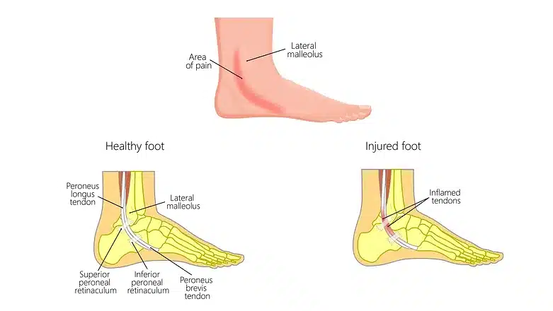 Peroneal Tendinopathy