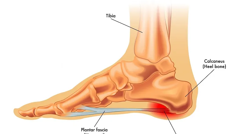 Plantar Fasciitis