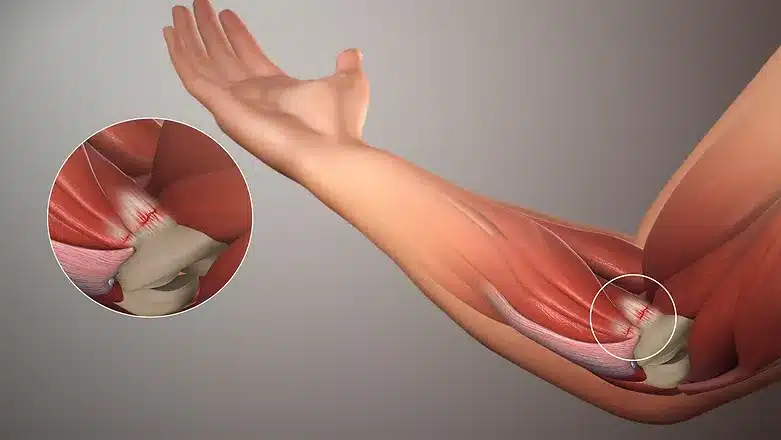 Radial Head Fracture