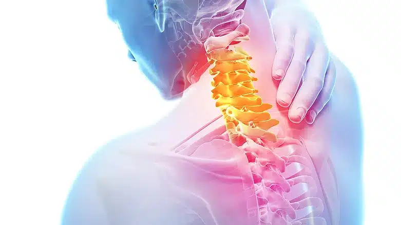 Radiculopathy