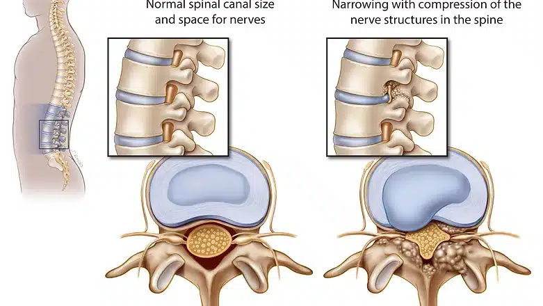 Spinal Stenosis