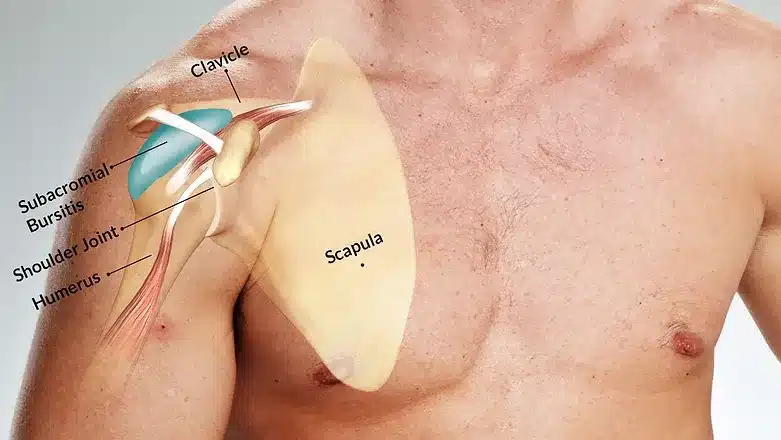 Subacromial Bursitis