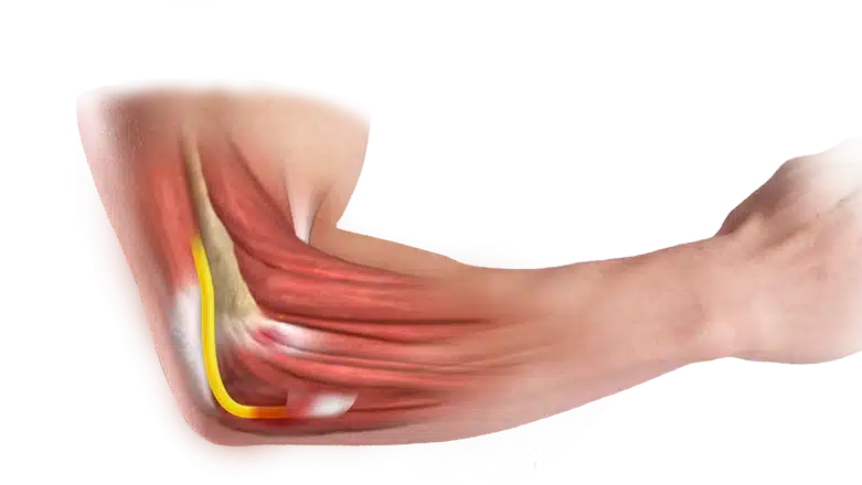 Tardy Ulnar Nerve Palsy