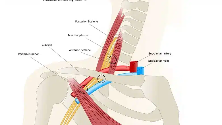 Thoracic Outlet Syndrome