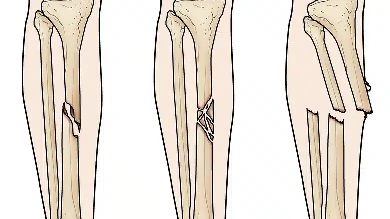 Tibia Fibula Shaft Fracture