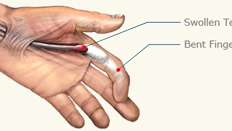 Trigger Finger