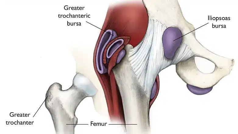 Trochanteric Bursitis