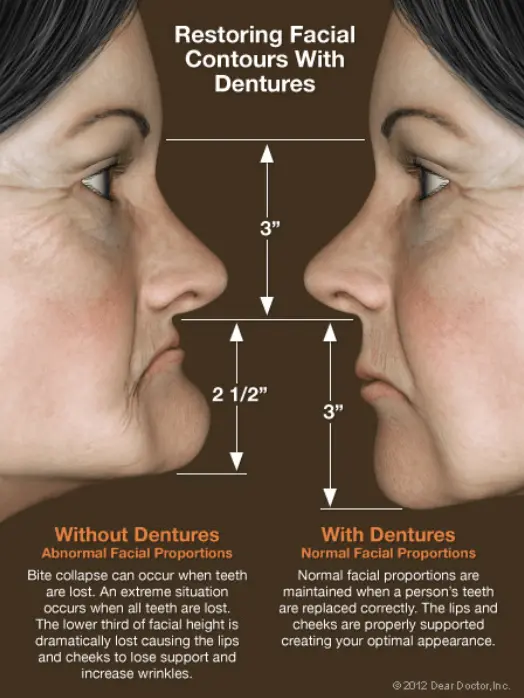 Restoring Facial Contours with Dentures