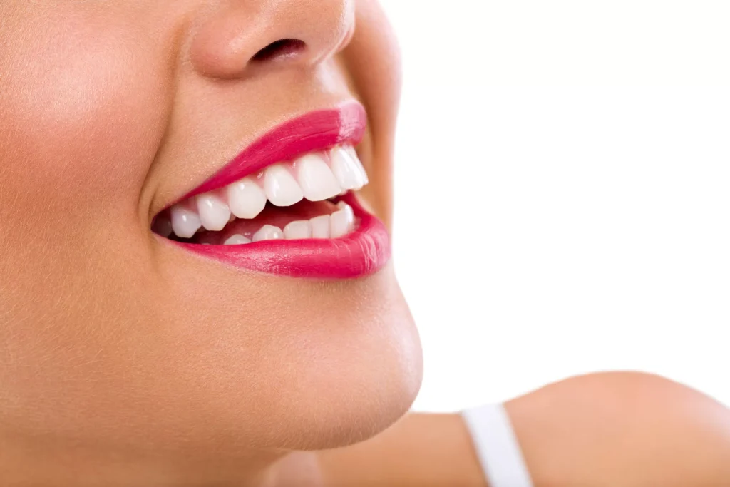 Veneers
