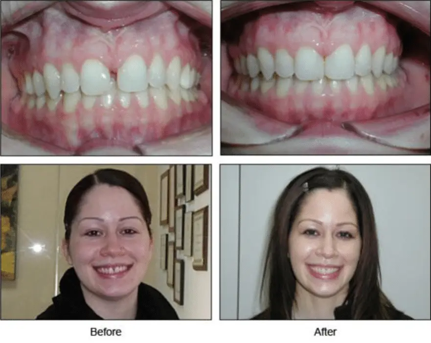 invisalign before and after